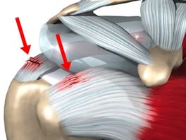 lesiones-futbol-americano-hombro.jpg