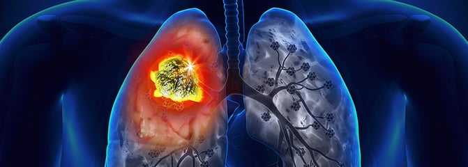 mejores_hospitales_de_mexico_cancer_de_pulmon.png