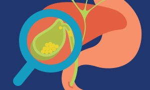 enfermedades-digestivas-comunes-calculos-1.jpg