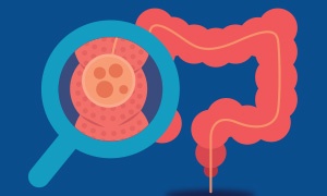 enfermedades-digestivas-comunes-colitis-1.png