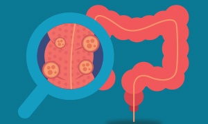 enfermedades-digestivas-comunes-diverticulitis-1.jpg