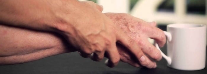 El Parkinson: ¿qué procede después del diagnóstico?