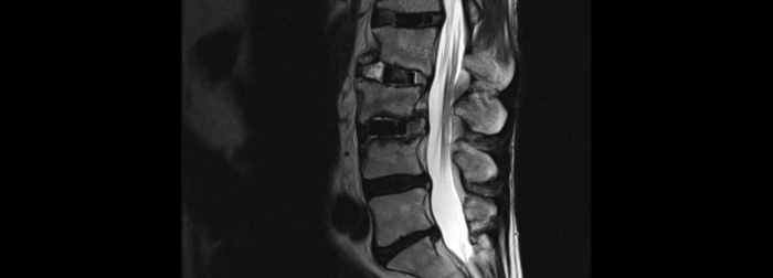 Lo que debes saber sobre un estudio de resonancia magnética lumbar